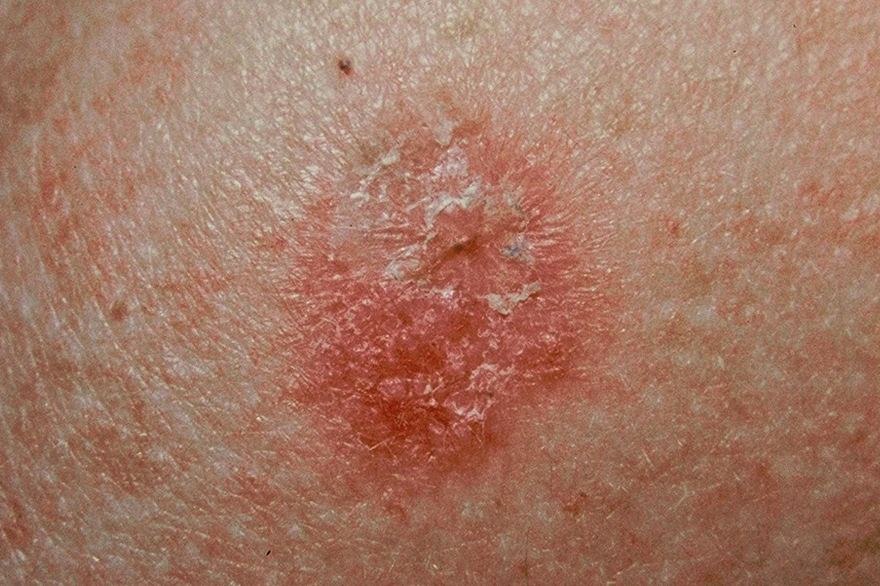 Cancer De La Peau Mortel l-influence-du-soleil.webnode.fr